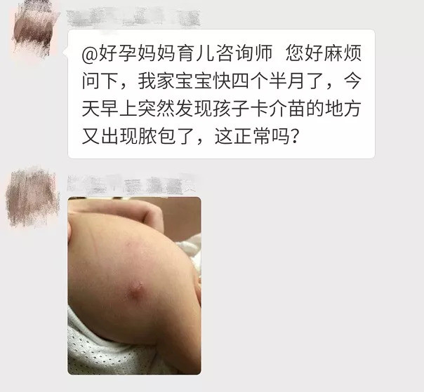 卡介苗处又出现脓包,正常吗?