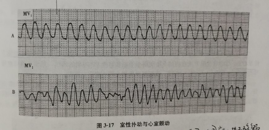 常见的17种心律失常,看图一目了然,你体检时仔细看心电图了没?