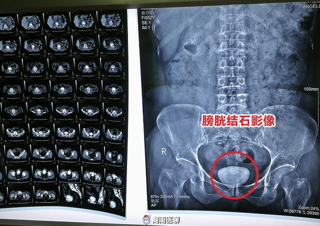 永州大妈膀胱结石,30年间开刀数十次,腹部疤痕似"怪兽