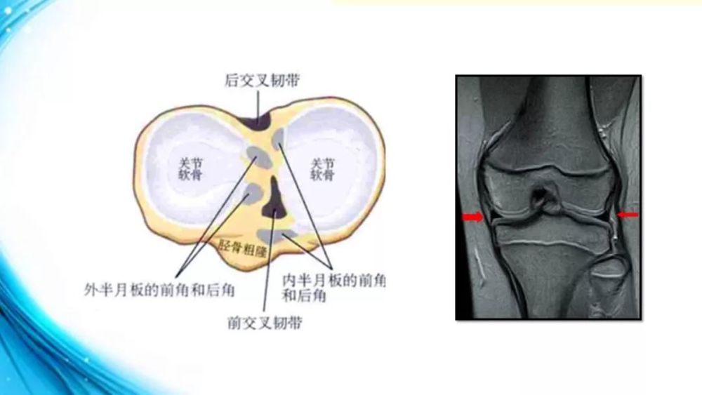 介于胫股关节之间的半月板随着膝关节屈伸,及小腿的旋转而做前后及内