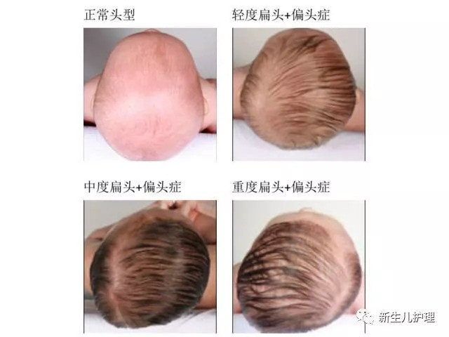 这包括可能两只耳朵看起来不对称,从头顶看宝宝,会发现宝宝头型有点像