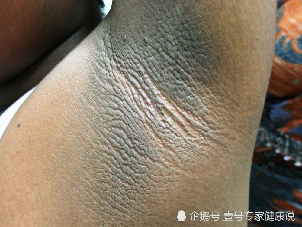 皮肤增生厉害,就会有天鹅绒样的表现,就是黑棘皮病