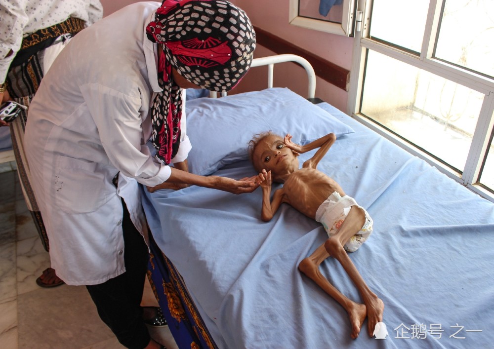 也门"最瘦儿童"揪了全世界的心 但这却是也门一代人的