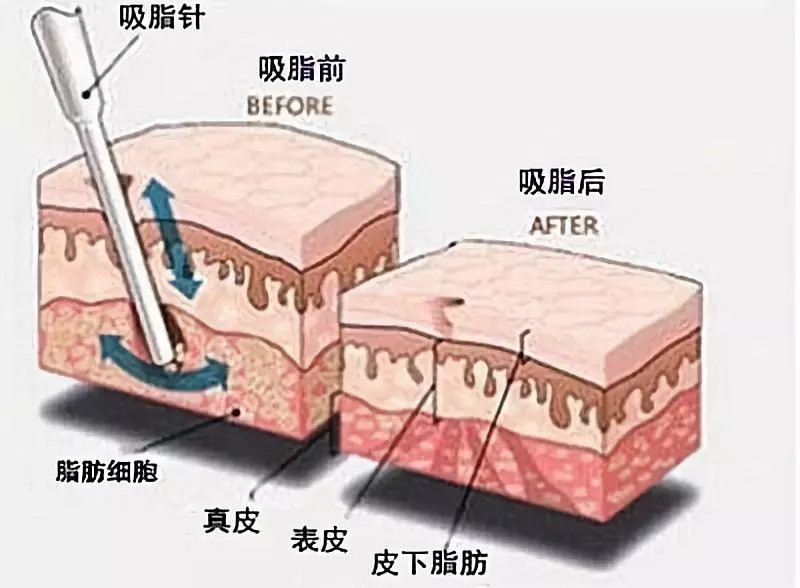 探入脂肪层把脂肪吸出来