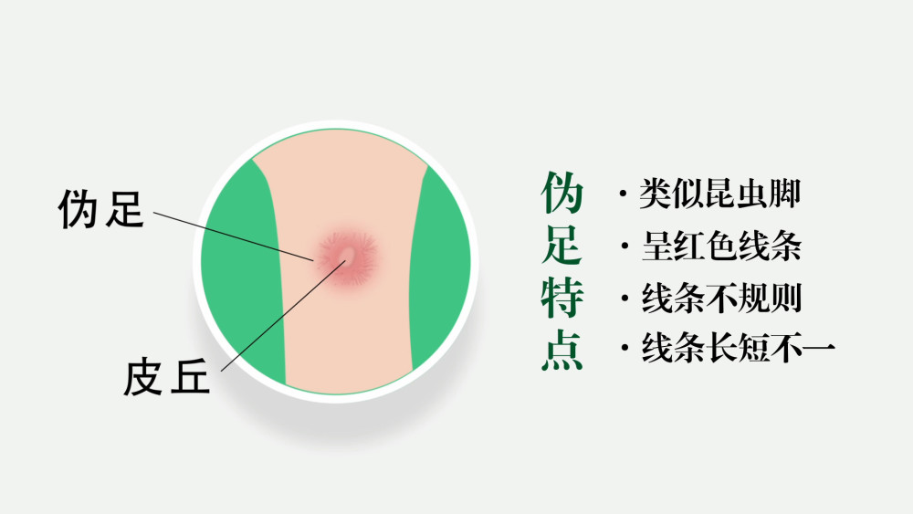 华中科技大学附属同济医院 注射室 郑丹莉介绍,皮试的时候如果皮丘