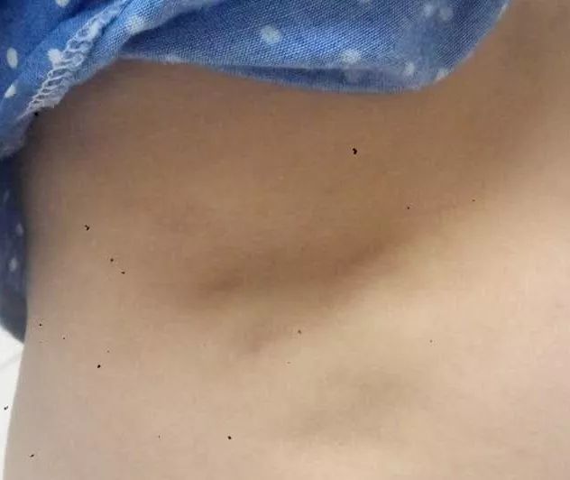 7岁女童臀部深深凹陷,去医院检查,结果让父母