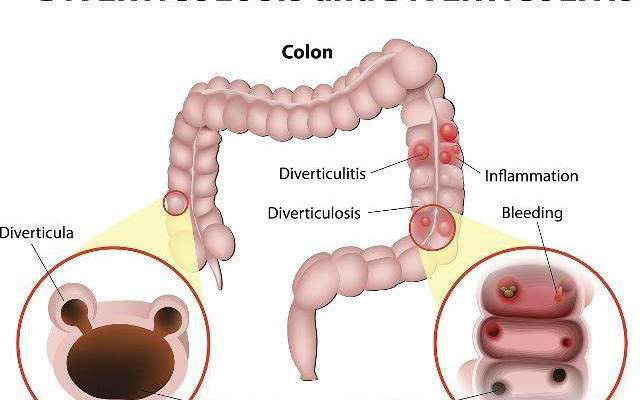 想清除肠道里的宿便,这4个方法很好用,简单方