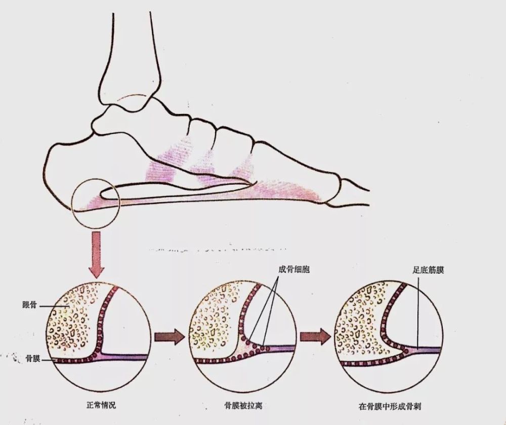 小腿三头肌——踝关节的保护伞