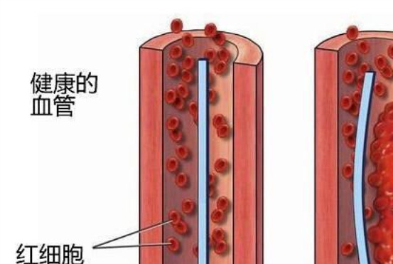 脚上出现四种表现,多数是"血管堵塞",三类人最好去查一下!