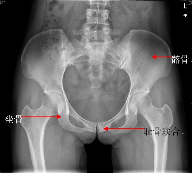 一,骨盆骨折 1)正常骨盆x线: 骨盆多发骨折:骨盆x线片及骨盆ct平扫