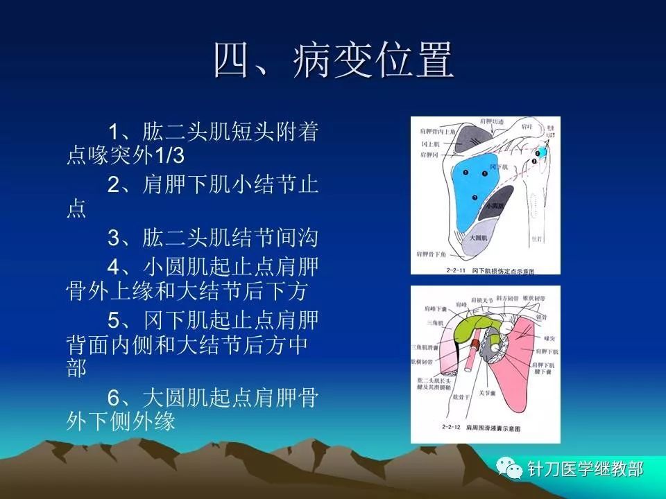 肩周炎标准针刀治疗