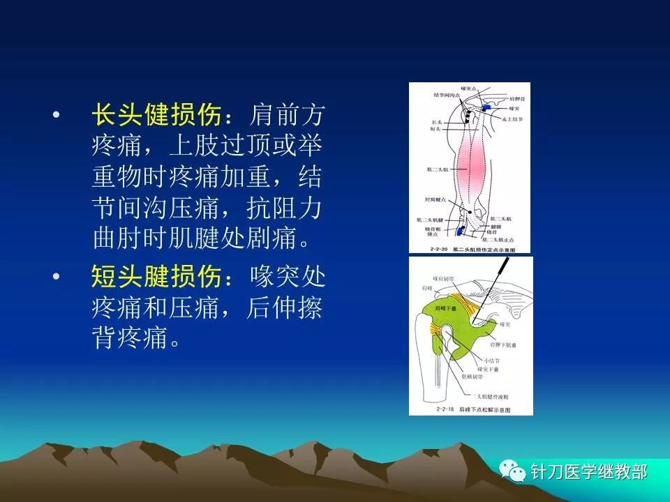 肩周炎标准针刀治疗