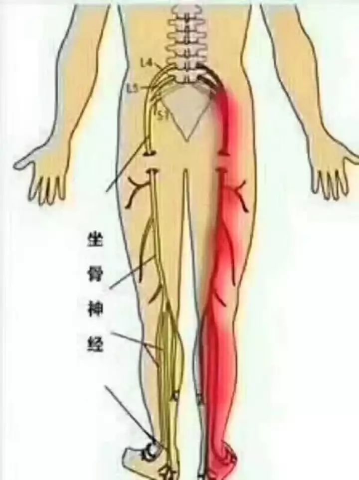 病根在腰,如果腰不治疗,即使腿现在不疼了,腰疼一复发,腿也会复发