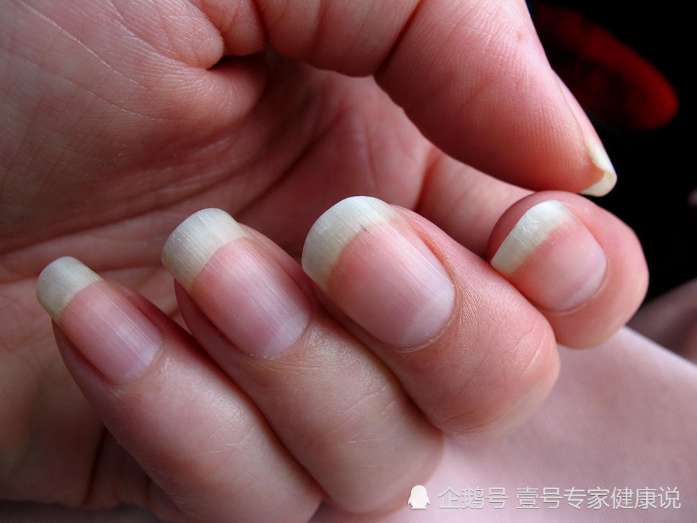 正常的人的指甲是粉红色的,圆润饱满,甲根会有白色半圆形的月牙痕