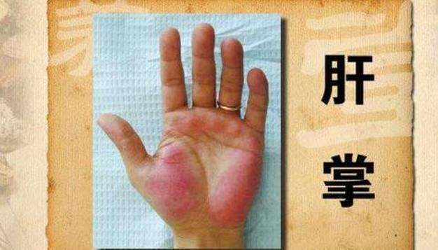 毛细血管充血严重,就会在手掌处形成所谓的片状充血斑块,按压后变苍白