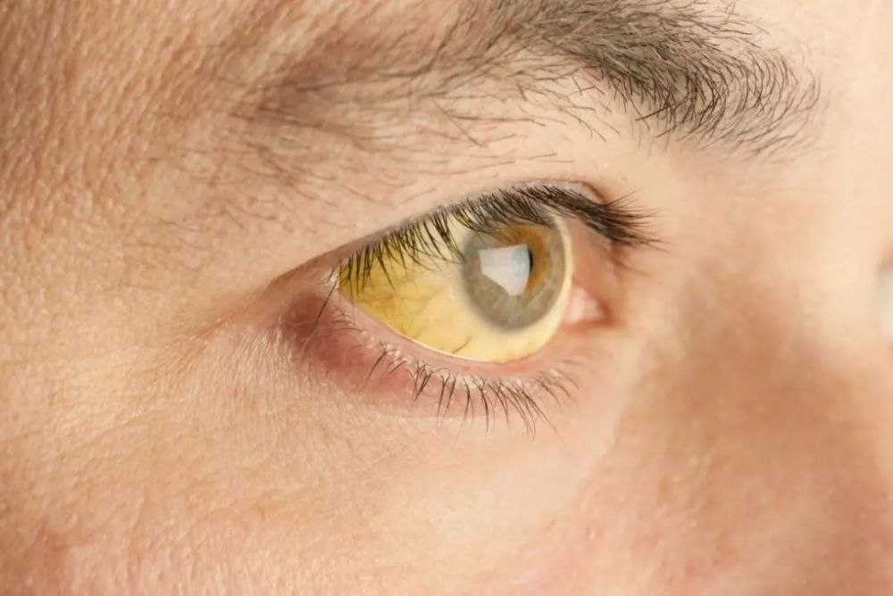 人的正常眼睛即巩膜(白眼球)是发白的,但有的人眼球却是发黄的,这是