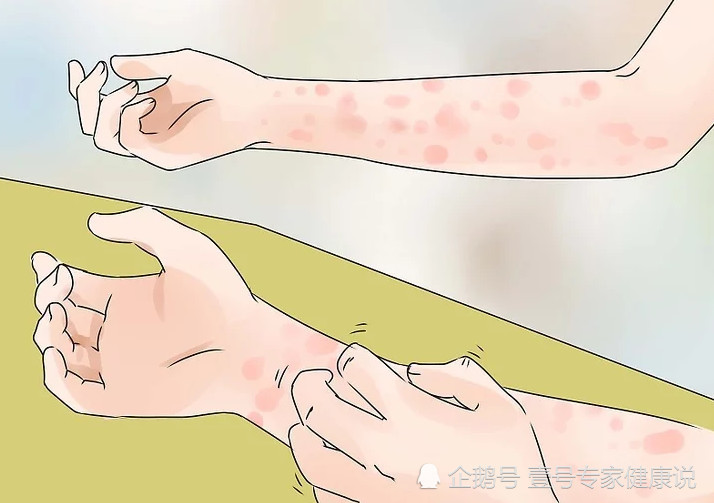 肝硬化,病毒性肝炎,都有可能出现全身皮肤瘙痒.