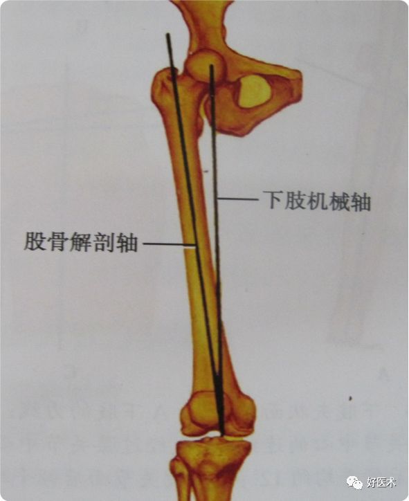 下肢力线测量方法最全汇总,赶紧收藏备用!