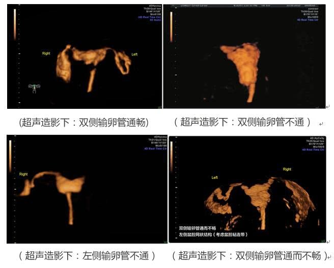 助力好孕 担心子宫输卵管造影的疼痛与辐射?可选择4d超声造影