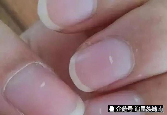 大家再来看一看这个问题:指甲上有白点说明缺锌缺钙?