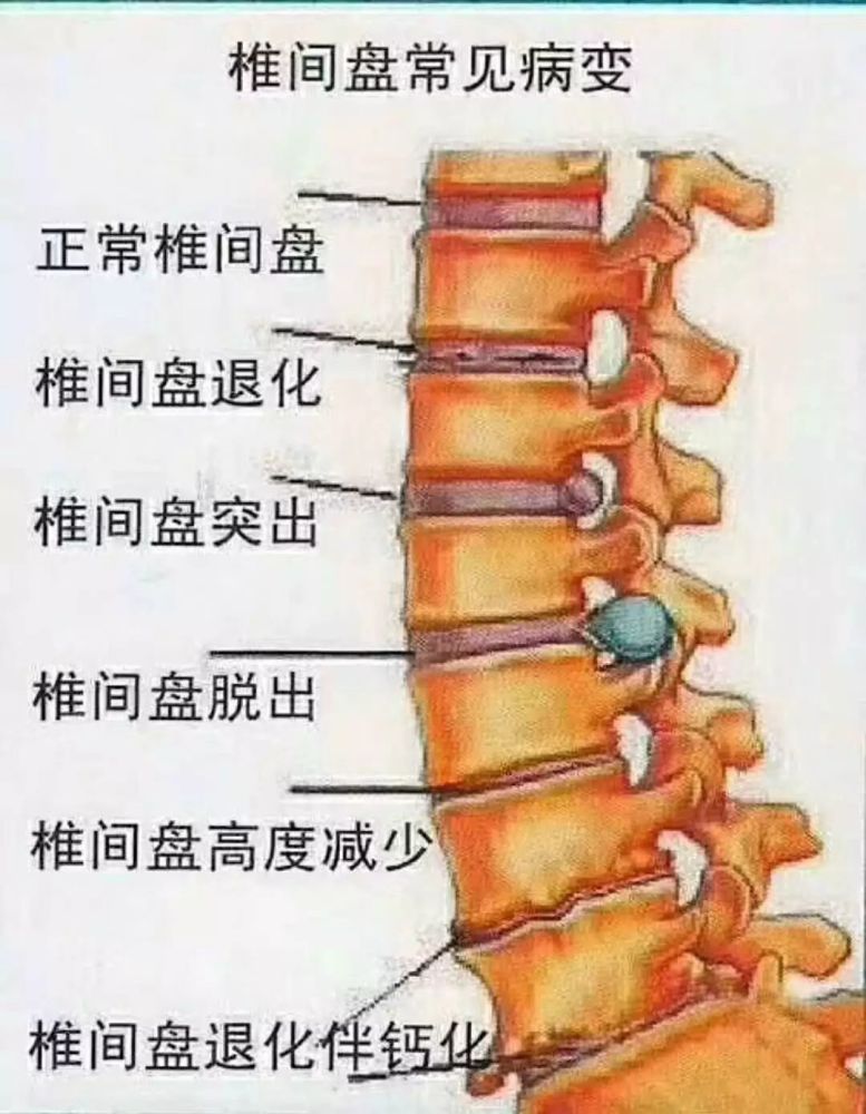 腰椎间盘突出可分为: 1,腰椎间盘膨出:即纤维环没有完全破裂, 髓核从
