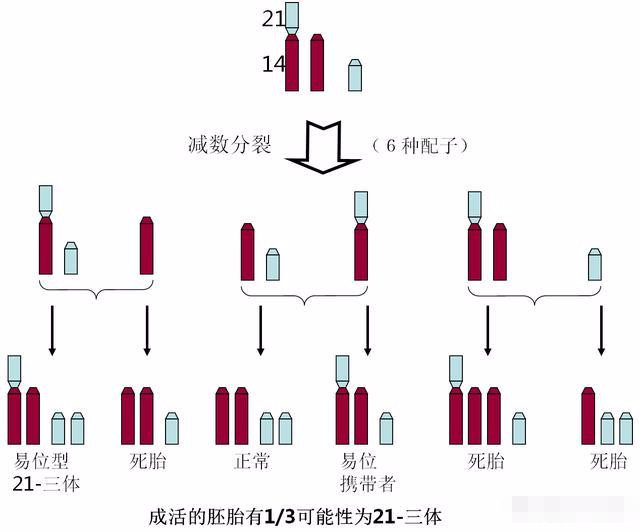 唐氏人口_例如克兰费尔特综合征