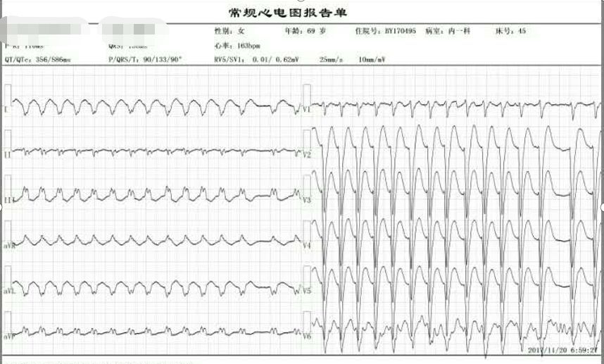 房颤扩心双心室起搏一例