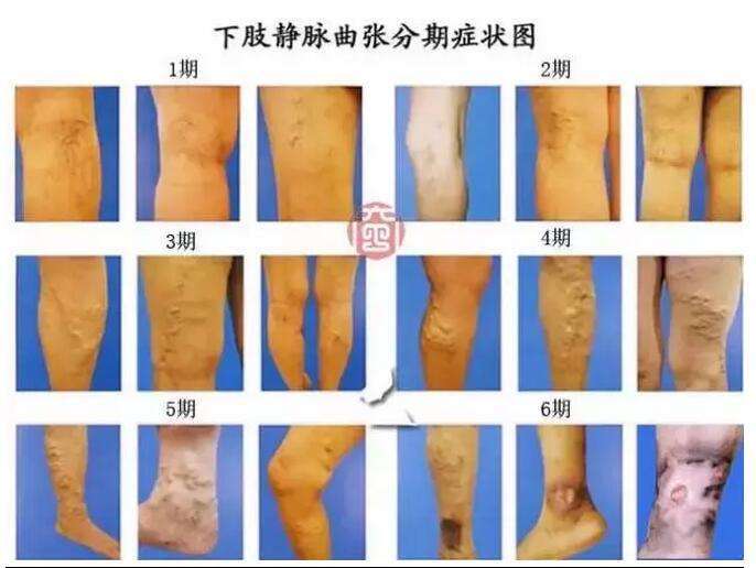 小腿静脉曲张,点压承山穴和涌泉穴!