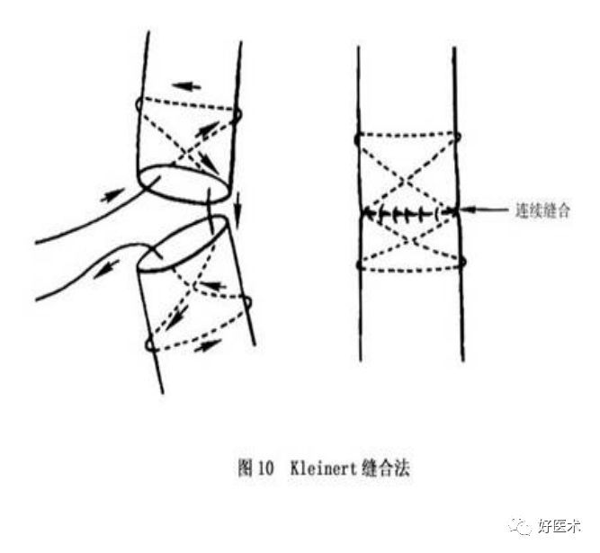 在原方法的基础上,肌腱缝合处加缝一圈间断缝合,以加强局部抗张能力