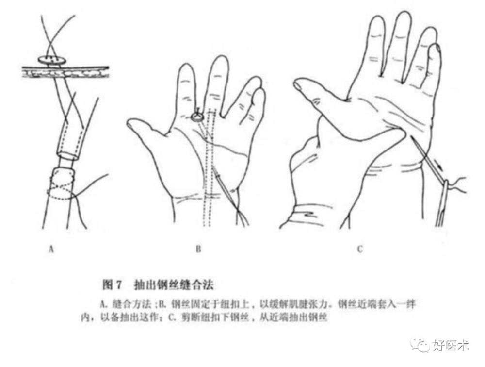 kessler缝合法