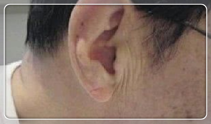 耳垂是耳朵反应心脑供血不足的最敏感的部位,耳垂上出现皱纹,自然就