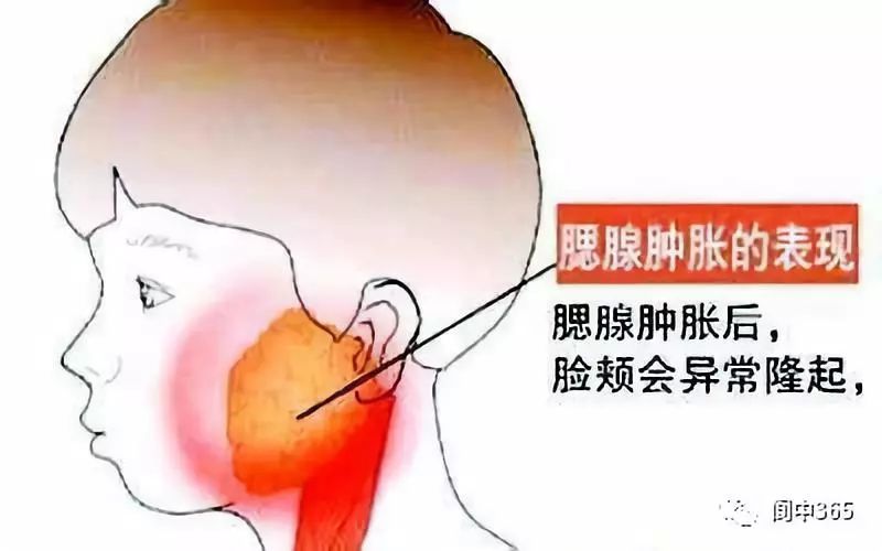 阆中出现流行性腮腺炎,9人被确诊