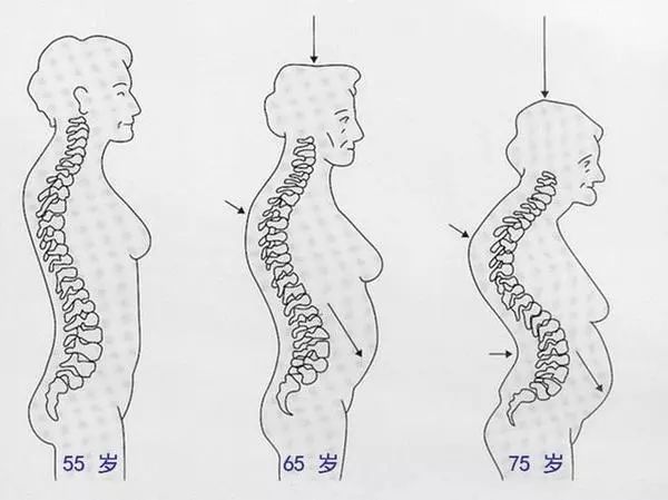 90%以上都是因为骨质疏松 人一旦到了年纪常常受其所困 1 胸腰椎骨折