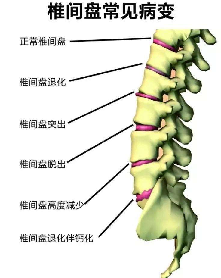 正常骨骼/骨质疏松 3 胸腰椎骨分型 通俗分法:稳定型和不稳定型