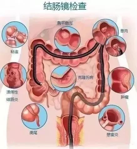 舒适胃镜,无痛胃肠镜的区别,都在这里!