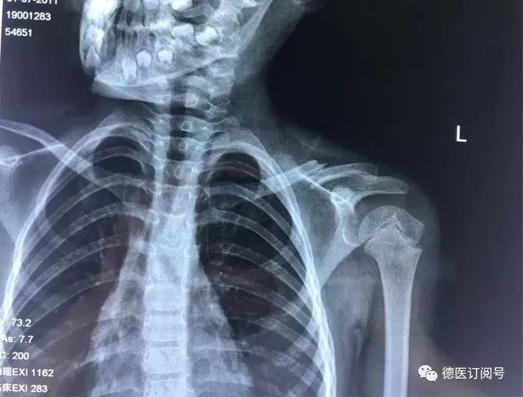 病例介绍: 患者女,6岁,在家玩耍时摔伤,诊断:左侧锁骨骨折,入院后