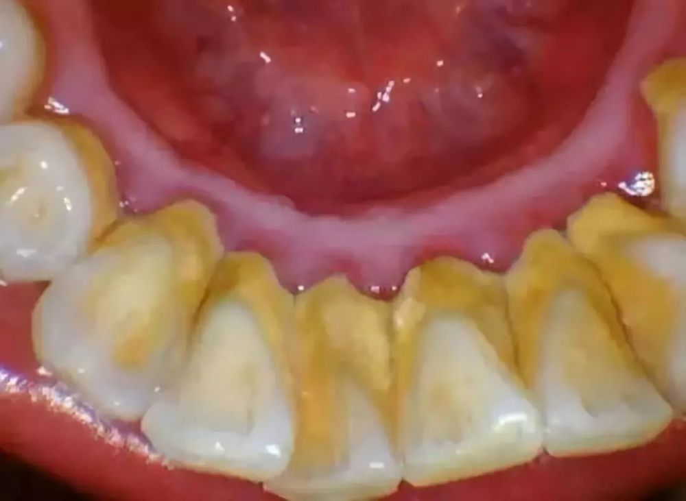 牙石,牙齿,洗牙