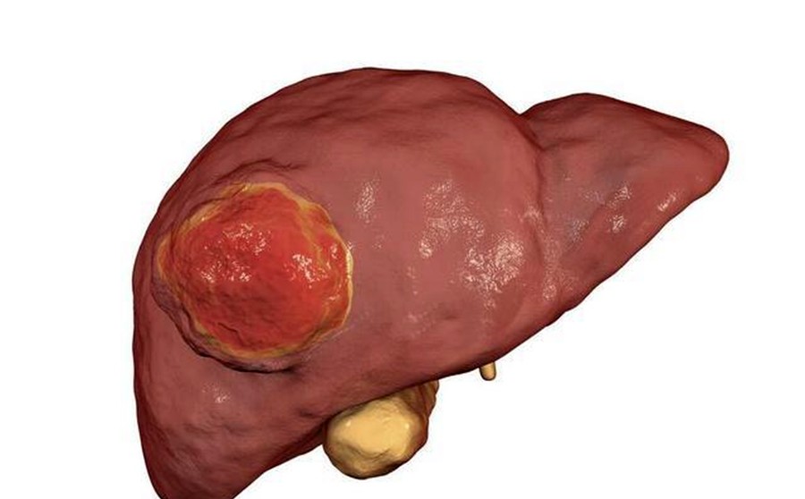 肝癌早期不痛不痒,如果脸上出现3种情况,可能是肝脏向