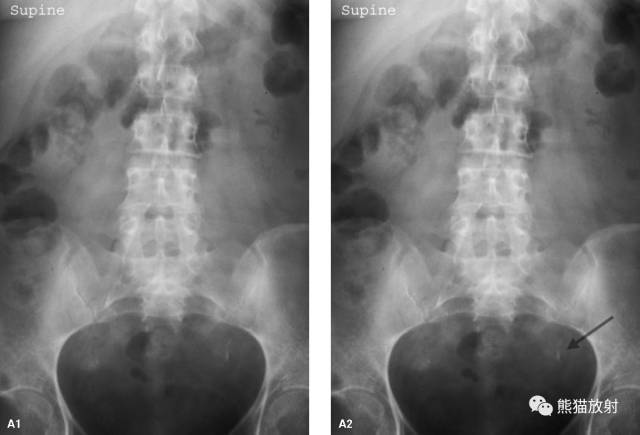 输尿管结石  ureteral stone