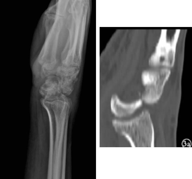 mri观察韧带及软组织损伤 头月关节脱位影像评价方法 腕关节正位x线片