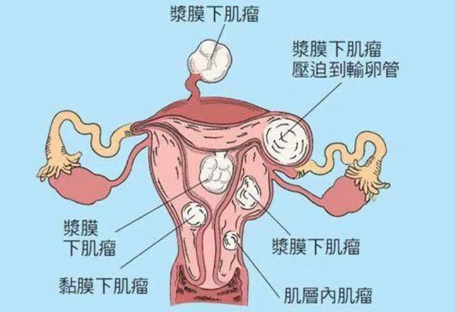 按其与子宫的关系可分三种类型: 肌壁间肌瘤,粘膜下肌瘤,浆膜下肌瘤