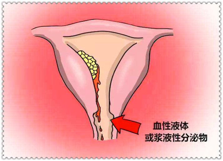 提醒女性:身体出现这4个变化,要重视,或许宫颈癌已经盯上你了