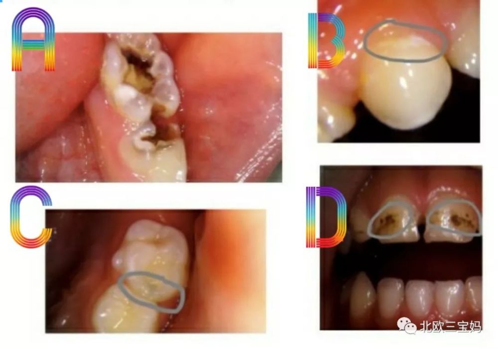 说明牙齿开始 慢慢脱框 c图:食物残渣长期聚集在两个牙齿之间,没有刷