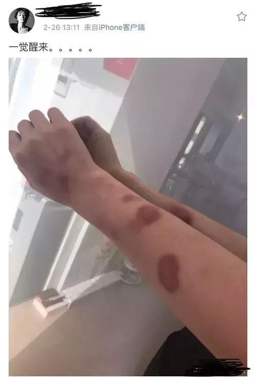 黄景瑜事件蓄谋已久,明星家暴已屡见不鲜?烟头烫,她手指被断!