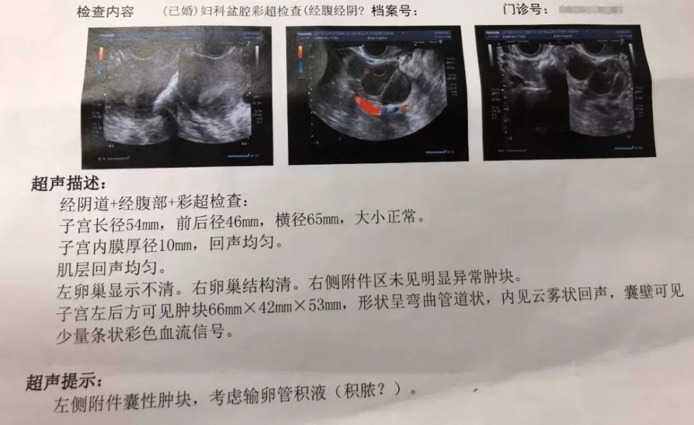 " "好好的输卵管怎么会积水呢?" "我的输卵管积水了又该怎么办呢?
