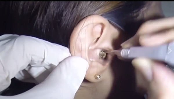 " 女病患的耳朵挖出了这么多的耳屎,不少网友惊呼:她是从出生都没挖过