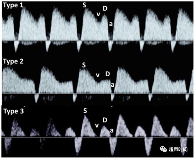 超声检查时记录静脉导管血流波形(图 1 和图 2),测量参数包括:a 波