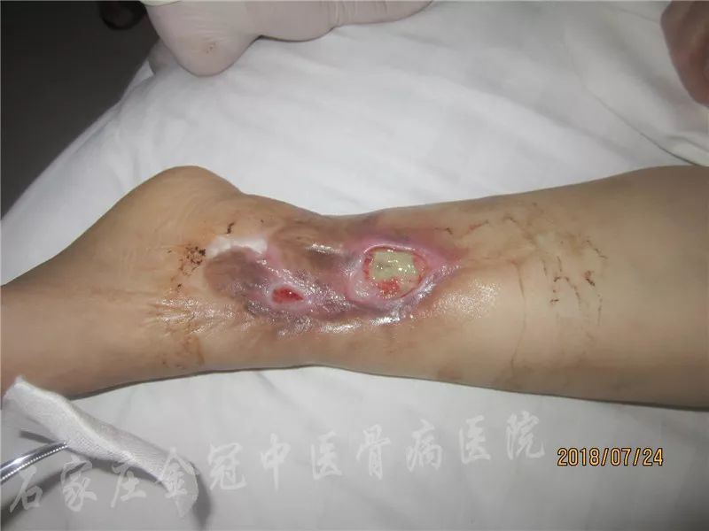 河北省石家庄市杜女士左小腿皮肤溃疡治疗恢复篇
