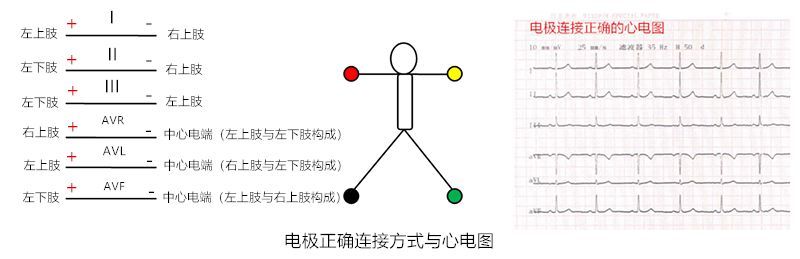 肢体导联电极错接的心电图分析及鉴别(上):四夹子导联