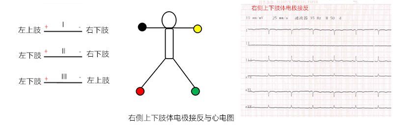 肢体导联电极错接的心电图分析及鉴别(上):四夹子导联